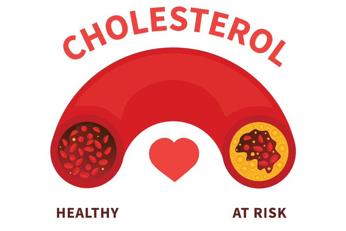 ilustración de una arteria con colesterol