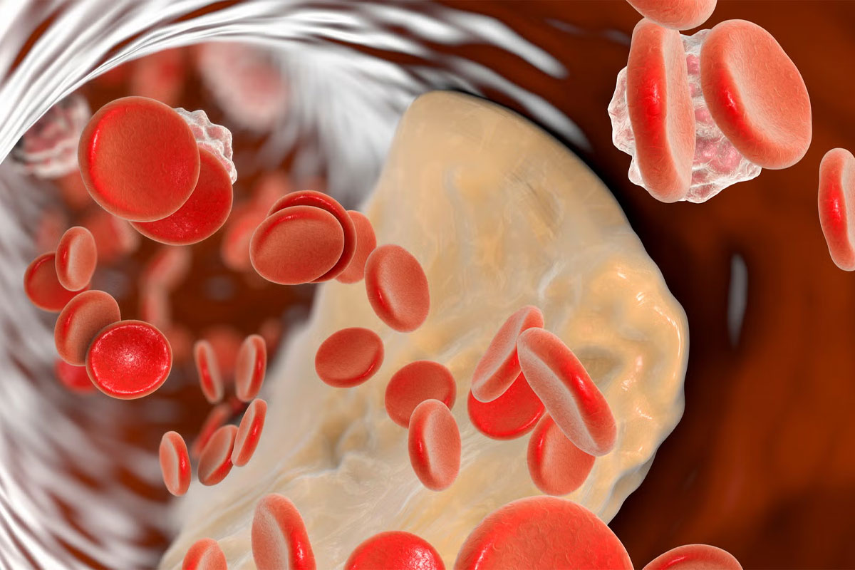 ilustración de colesterol en la sangre